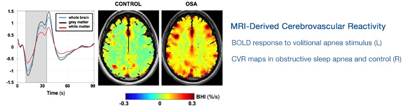 LSPFI Research Image: MRI-Derived Cerebrovascular Reactivity (CVR)